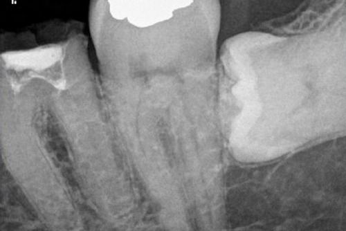 Пример лечения зубных каналов №13
