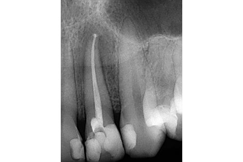 Пример лечения зубных каналов №14