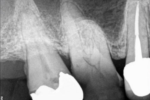 Пример лечения зубных каналов №12