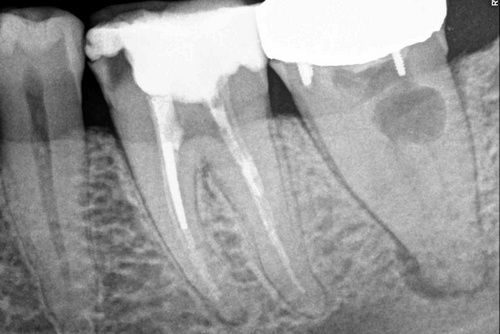 Пример лечения зубных каналов №11