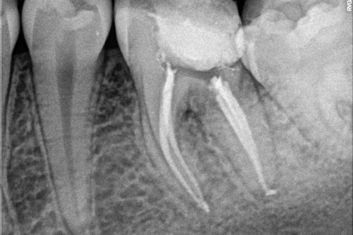 Пример лечения зубных каналов №7