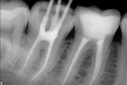 Пример лечения зубных каналов №10