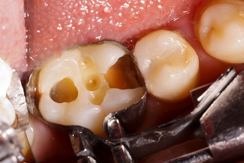 Пример лечения зубных каналов №9