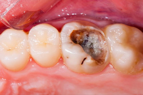 Пример лечения зубных каналов №8