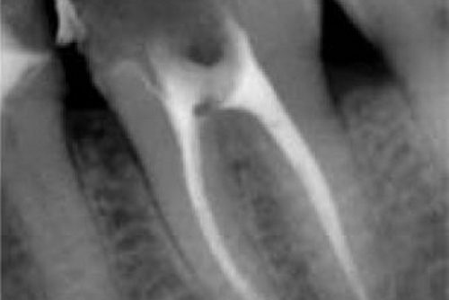 Пример лечения зубных каналов №4