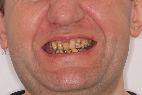 Пример имплантации зубов №14
