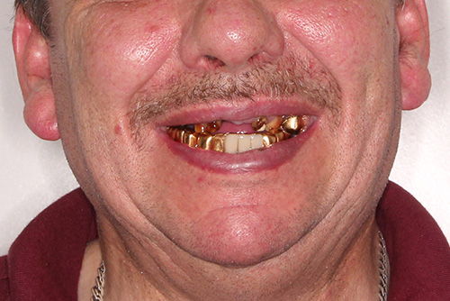 Пример имплантации зубов №23