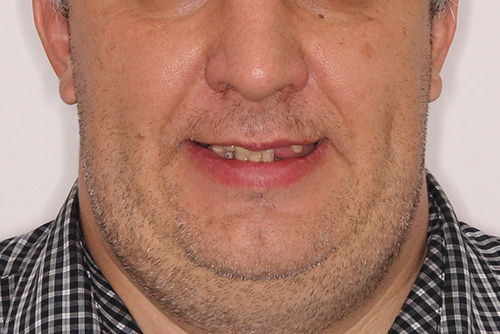 Пример имплантации зубов №22