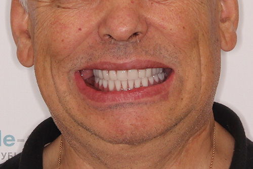 Пример имплантации зубов №20