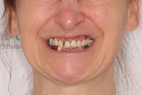 Пример имплантации зубов №19