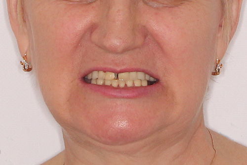 Пример имплантации зубов №18