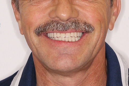 Пример имплантации зубов №17