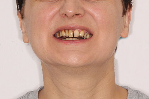 Пример имплантации зубов №16