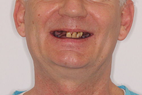 Пример протезирования зубов №11