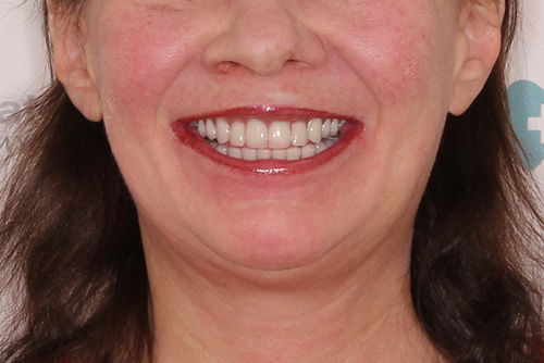Пример протезирования зубов №12