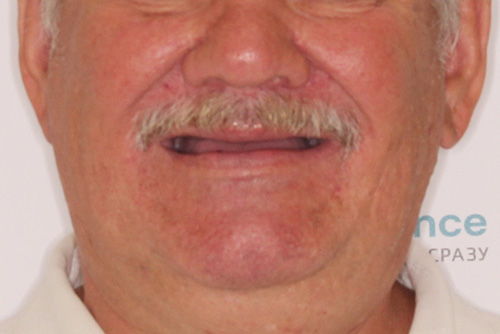 Пример протезирования зубов №13