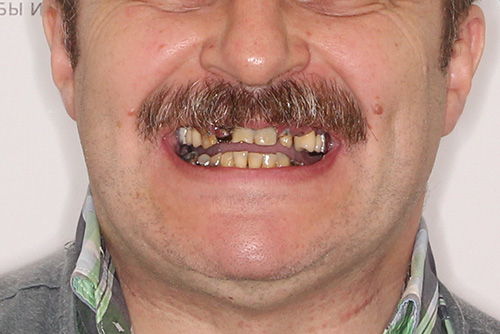 Пример протезирования зубов №15