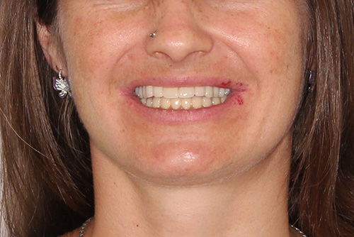 Пример протезирования зубов №16