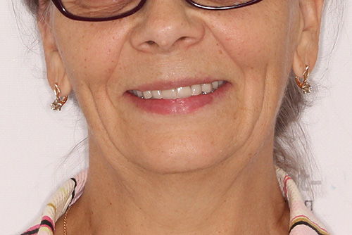 Пример протезирования зубов №17