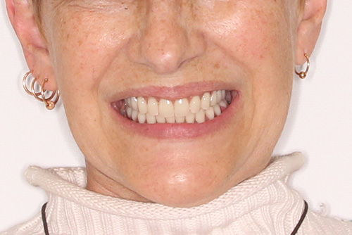 Пример протезирования зубов №18