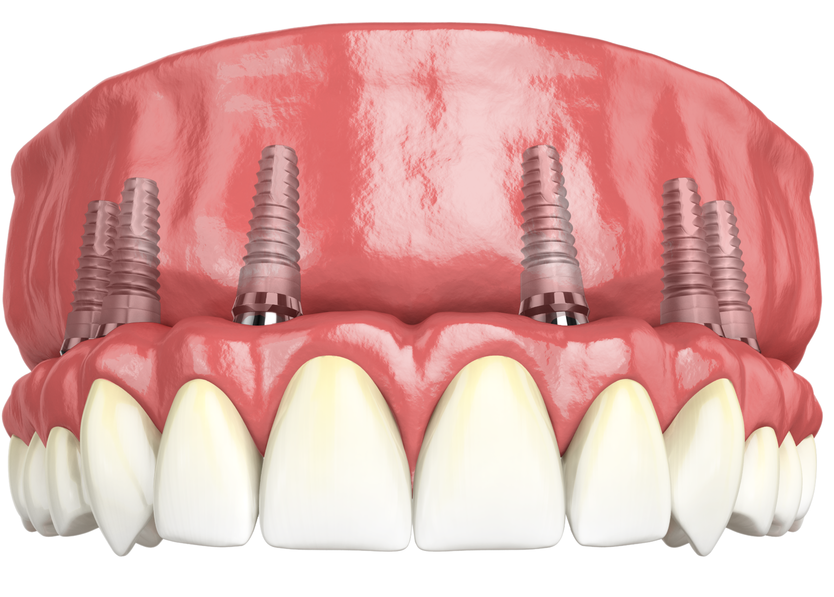 Комплекс All-on-6 (Nobel Biocare) — Новые зубы за 1 день