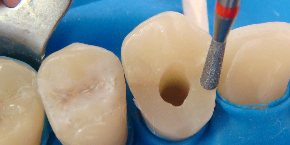 распломбировка каналов зуба