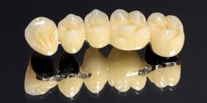 металлокерамические зубные протезы