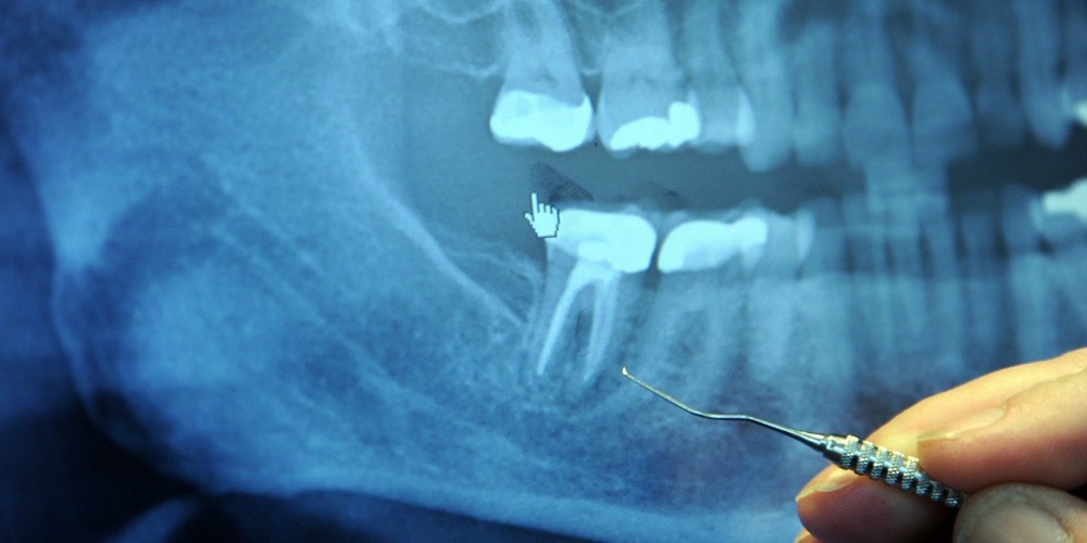 перфорация каналов зуба