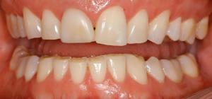 стираемость зубов