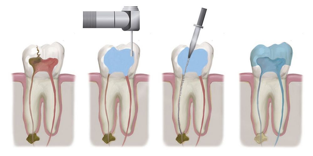 этапы лечения каналов зуба