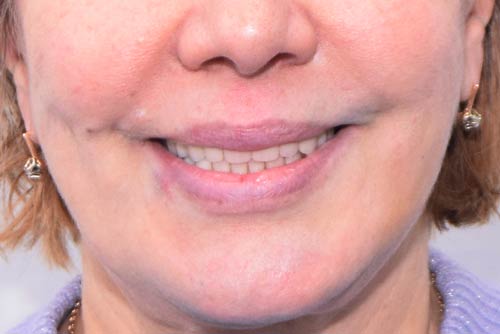 Пример имплантации зубов №3