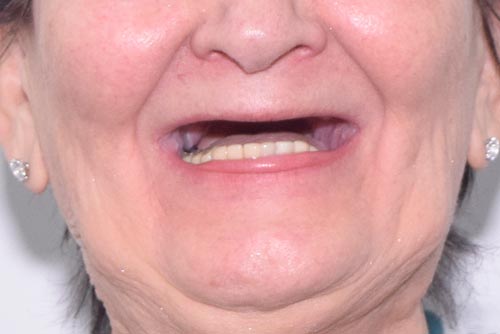 Пример имплантации зубов №7