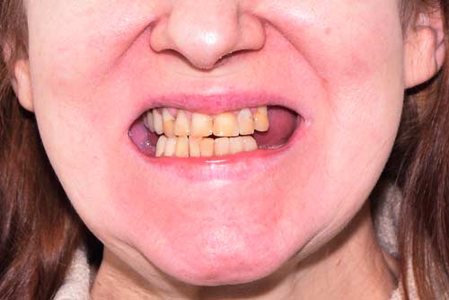 Пример имплантации зубов №6