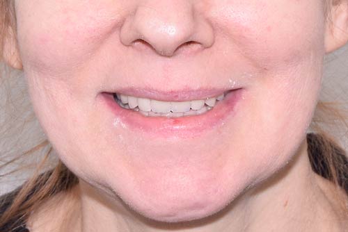 Пример имплантации зубов №6