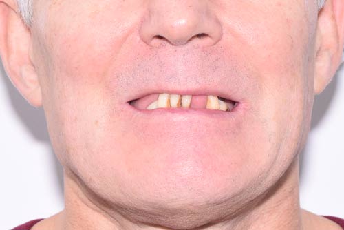 Пример имплантации зубов №15