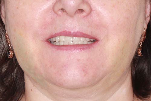Пример имплантации зубов №9