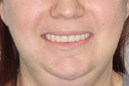 Пример имплантации зубов №5