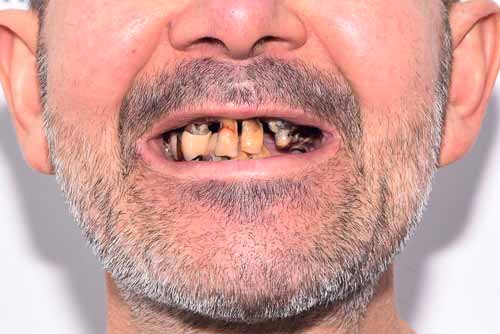 Пример имплантации зубов №4