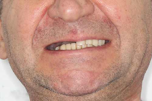 Пример имплантации зубов №8