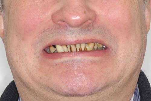 Пример имплантации зубов №1