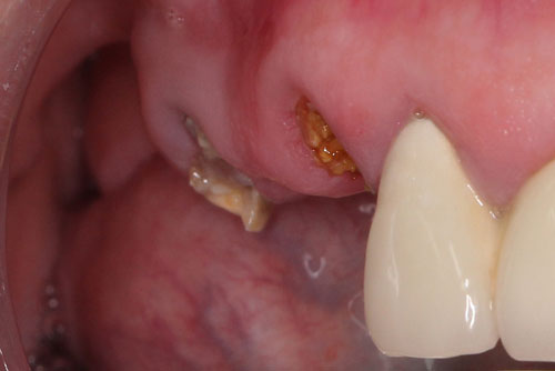 Пример имплантации зубов №12