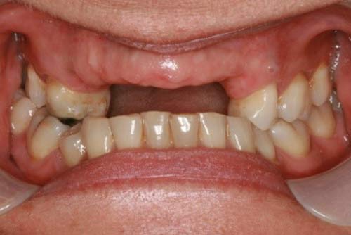 Пример имплантации зубов №11