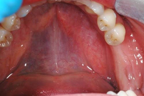 Пример имплантации зубов №10