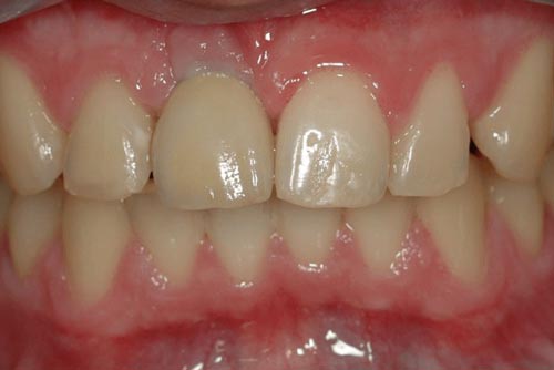 Пример имплантации зубов №13