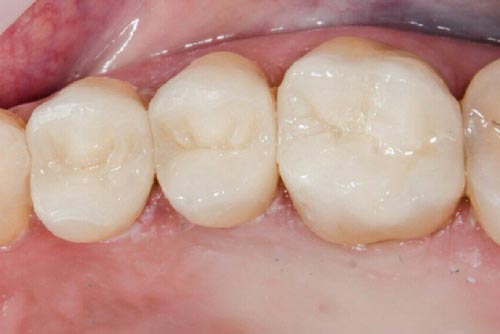 Пример лечения зубных каналов №5