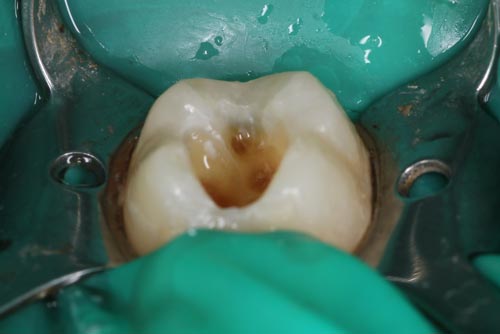 Пример лечения зубных каналов №2