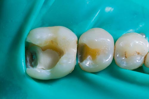 Пример лечения зубных каналов №6