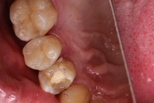 Пример лечения зубных каналов №3