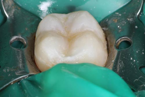 Пример лечения зубных каналов №2