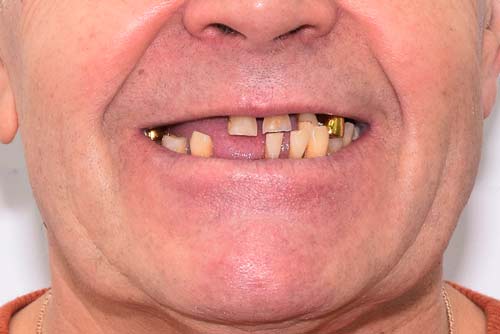 Пример протезирования зубов №4